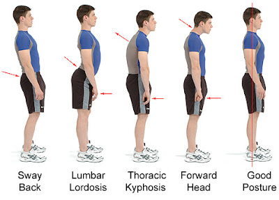 Before/after comparison showing common postural deviations - forward head, rounded shoulders, anterior pelvic tilt