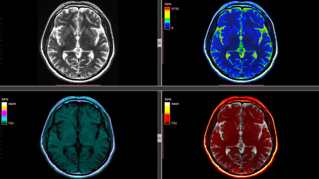 What Brain Scans Actually Show About Meditators